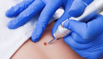 Dermoscopy: An Atlas