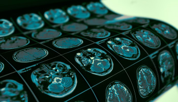 Living clinical guidelines for stroke: updates, challenges and opportunities