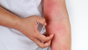 Management of atopic dermatitis: a narrative review