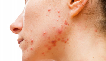 Acne and its psychological impacts